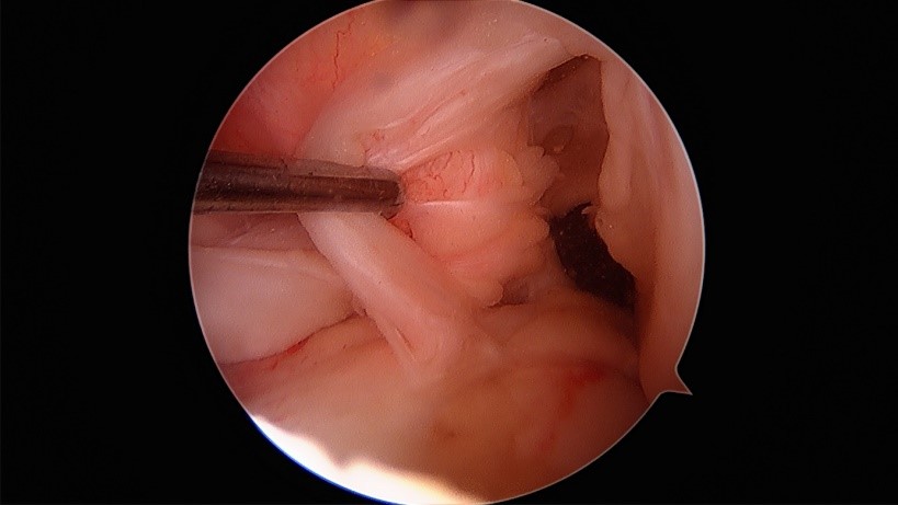 損傷後の弱々しい前十字靭帯の関節鏡画像