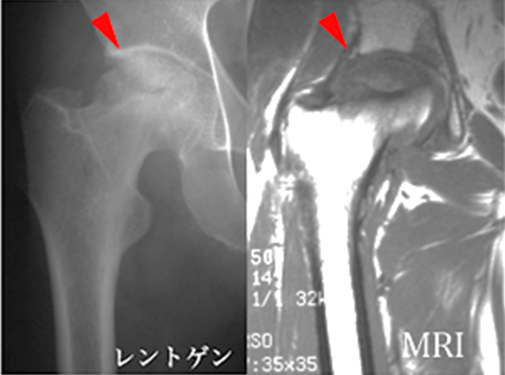 代替骨頭壊死症
