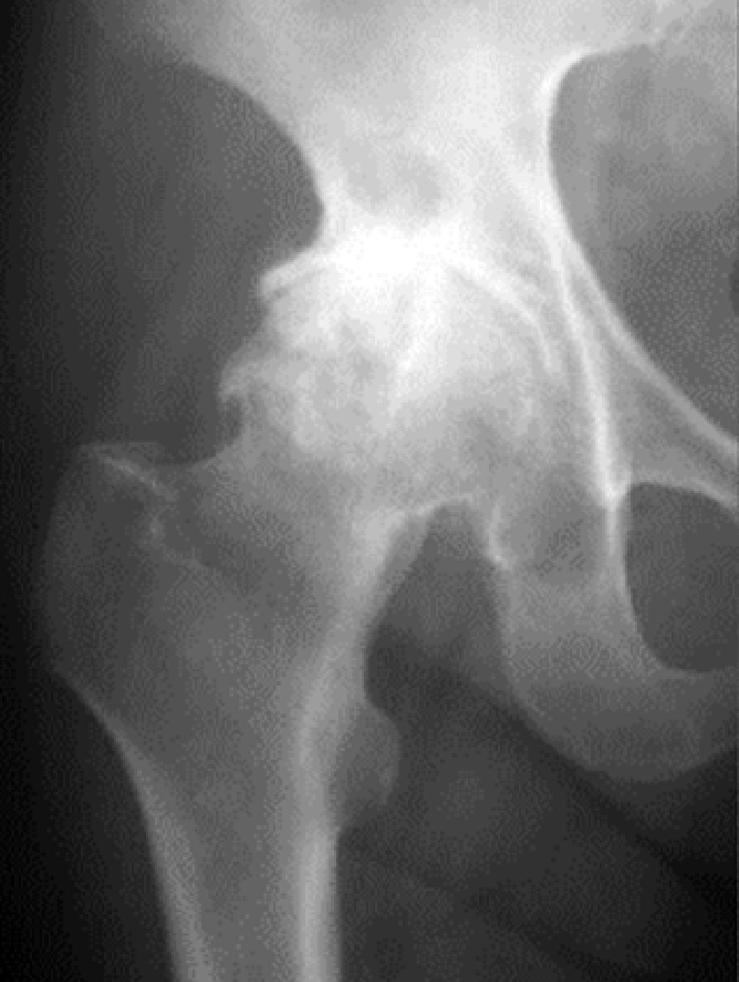 変形性股関節症