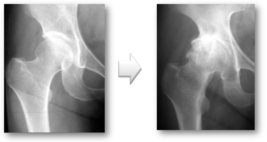 一次性の変形性股関節症