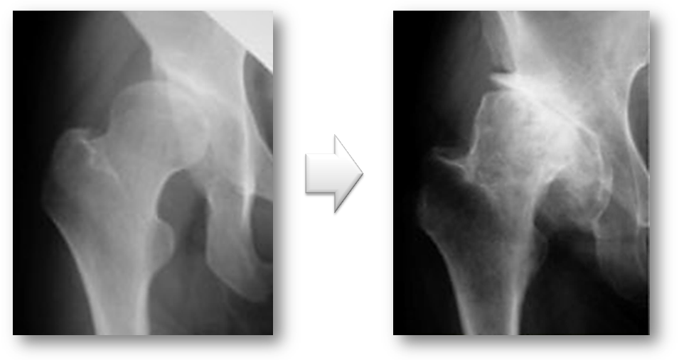 二次性の変形性股関節症