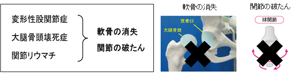 股関節症の病態図