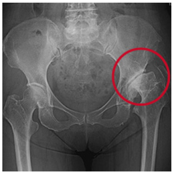 股関節症の症状図