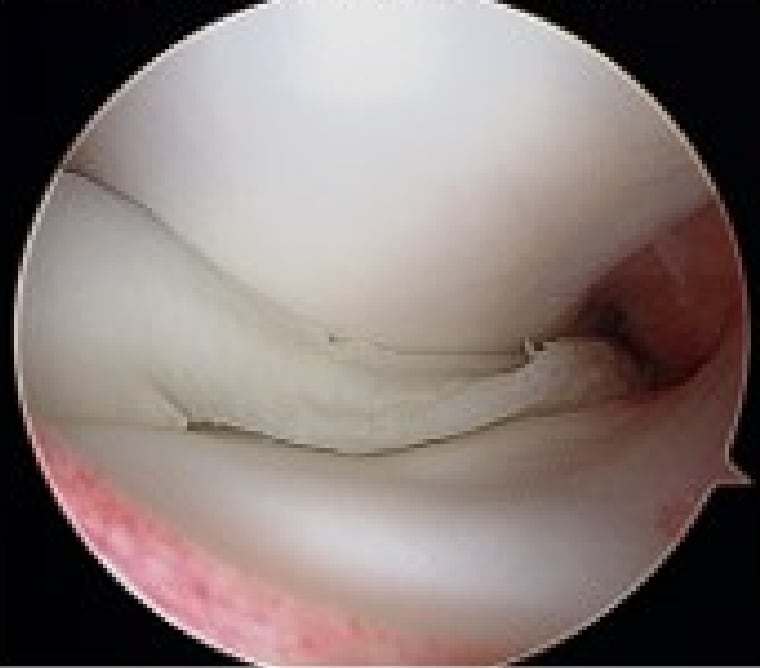 断裂して変形している