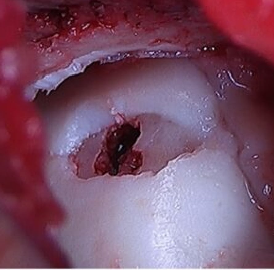 骨軟骨柱移植前