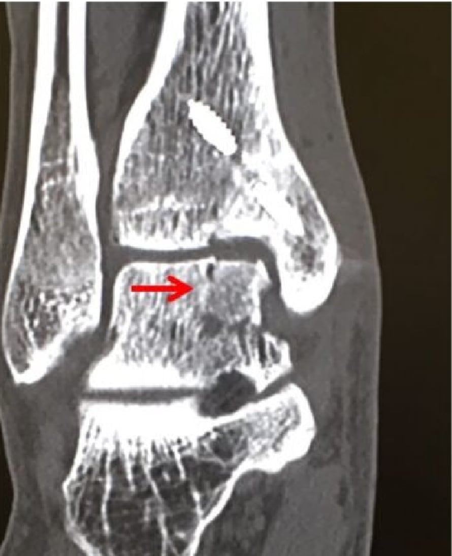 術後6ヶ月経過CT 1