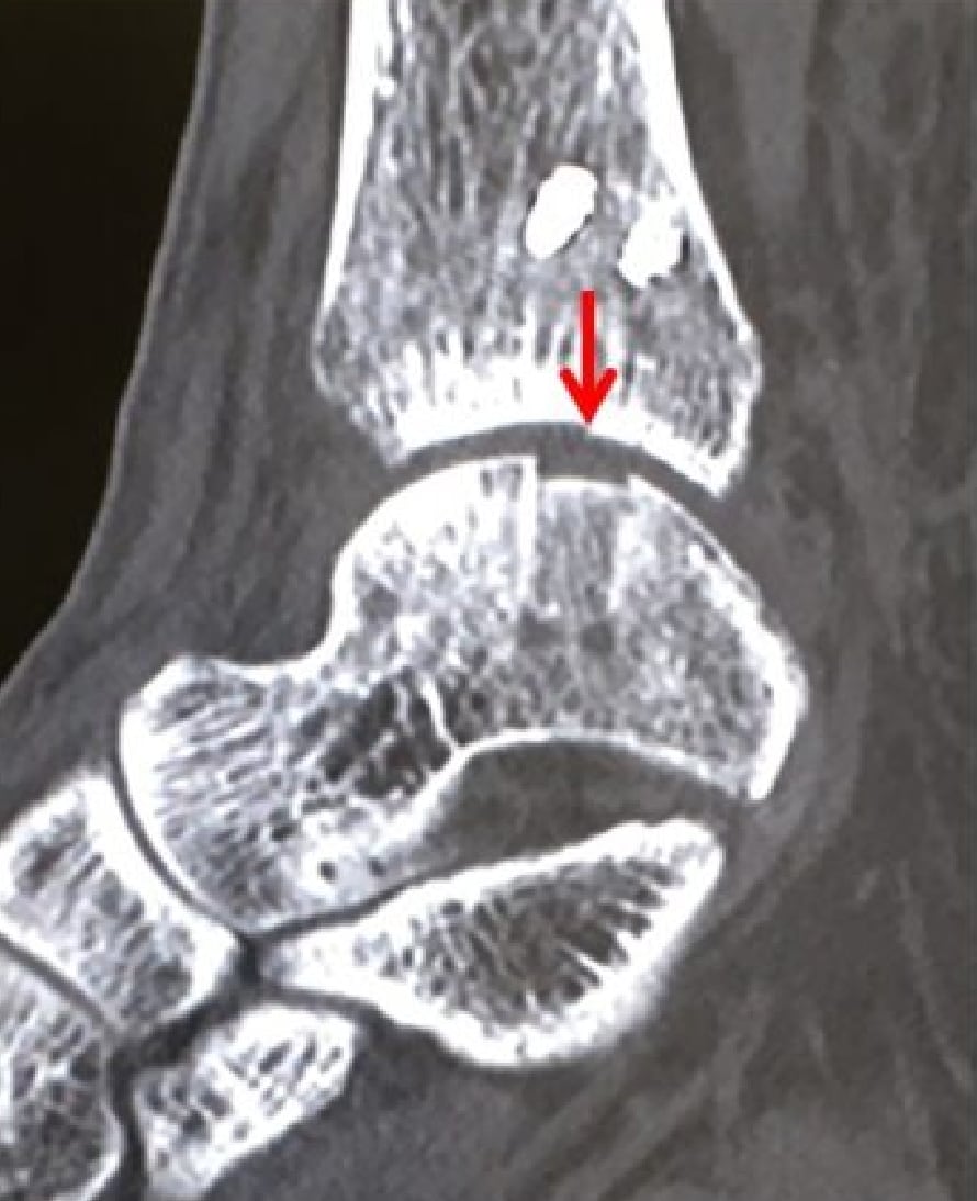 術後6ヶ月経過CT 2