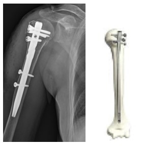 髄内釘のレントゲン画像