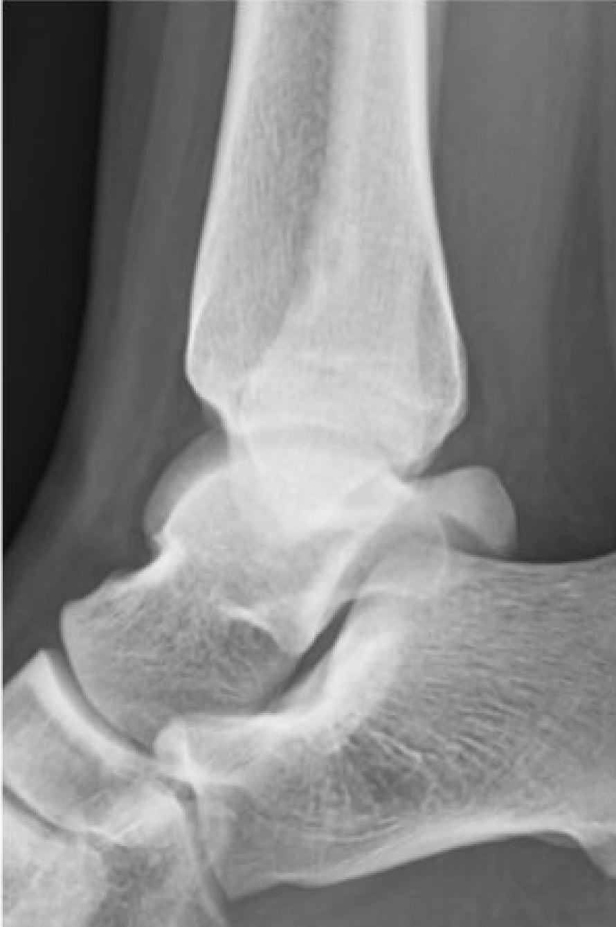 術前 レントゲン画像