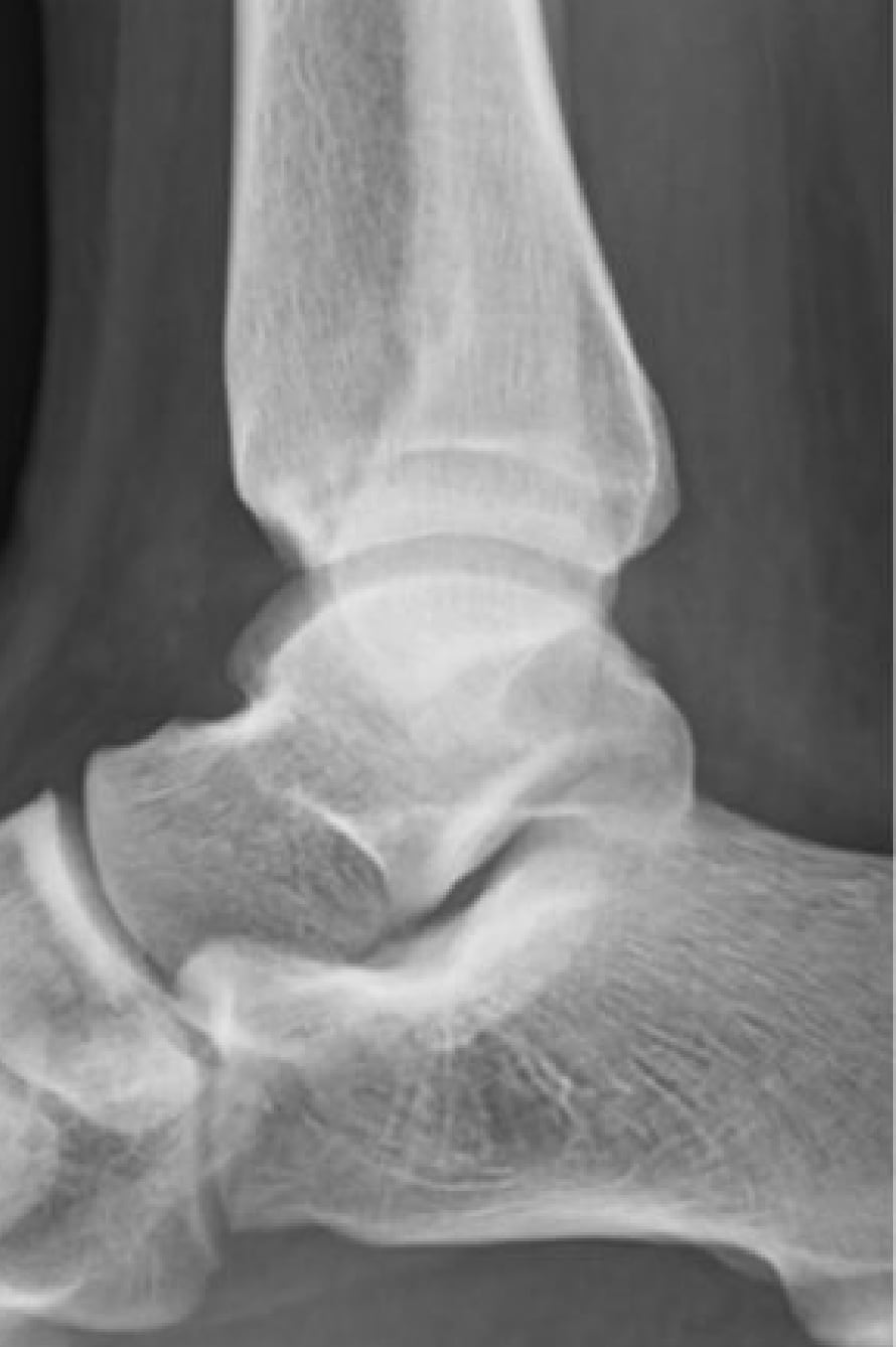 術後 レントゲン画像