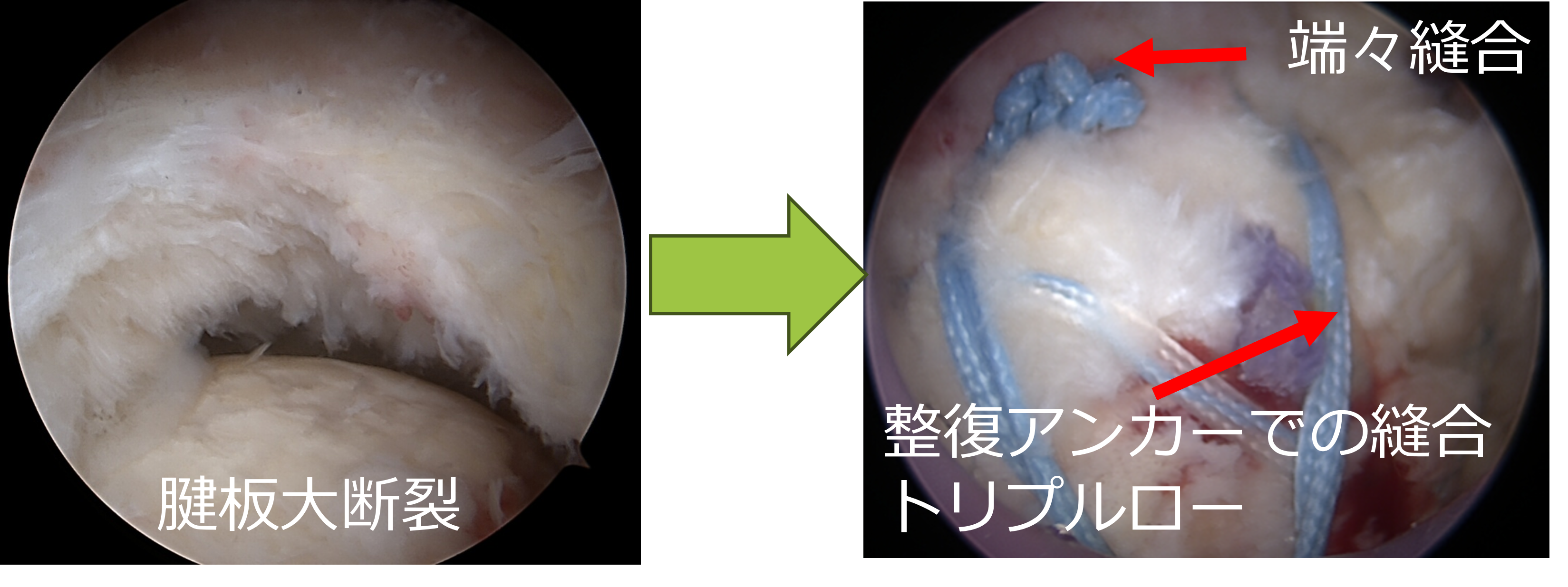 腱板縫合の画像