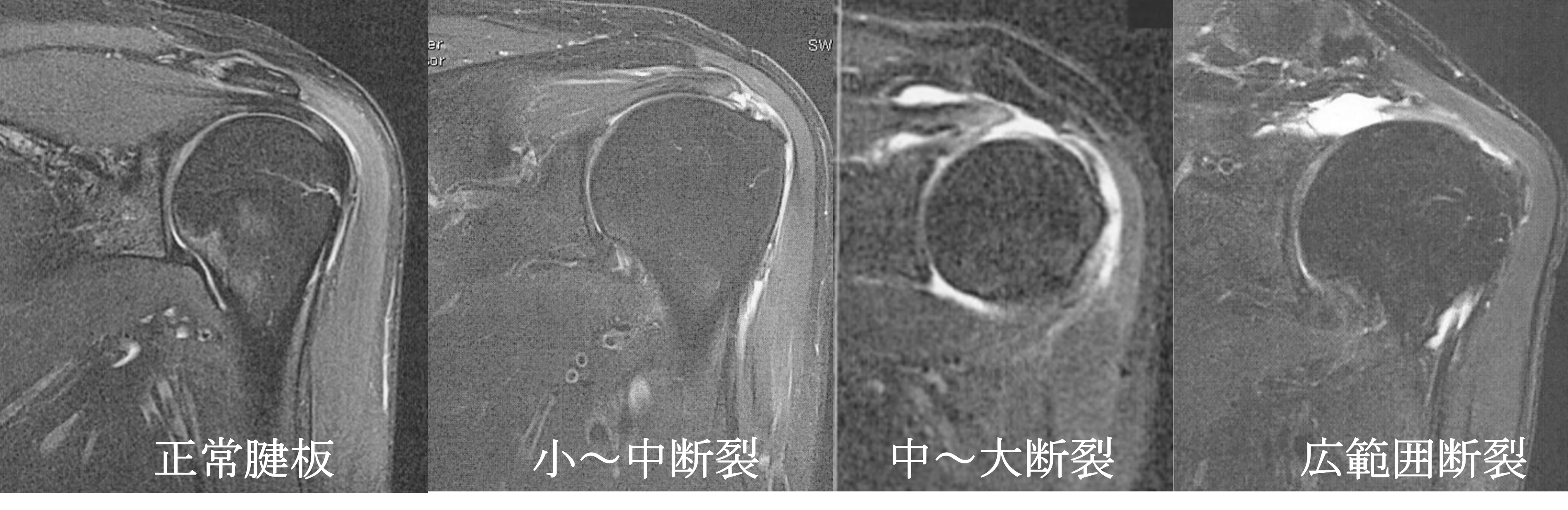 腱板断裂の大きさの分類