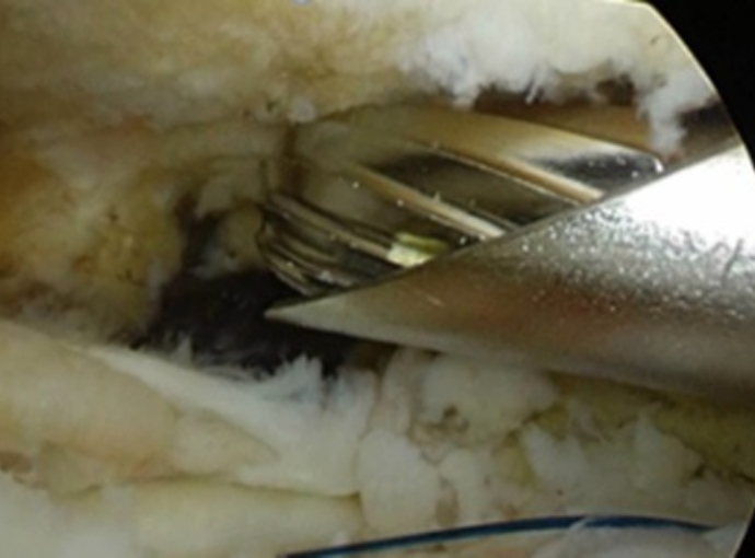 滑膜切除、肩峰下除圧の様子3