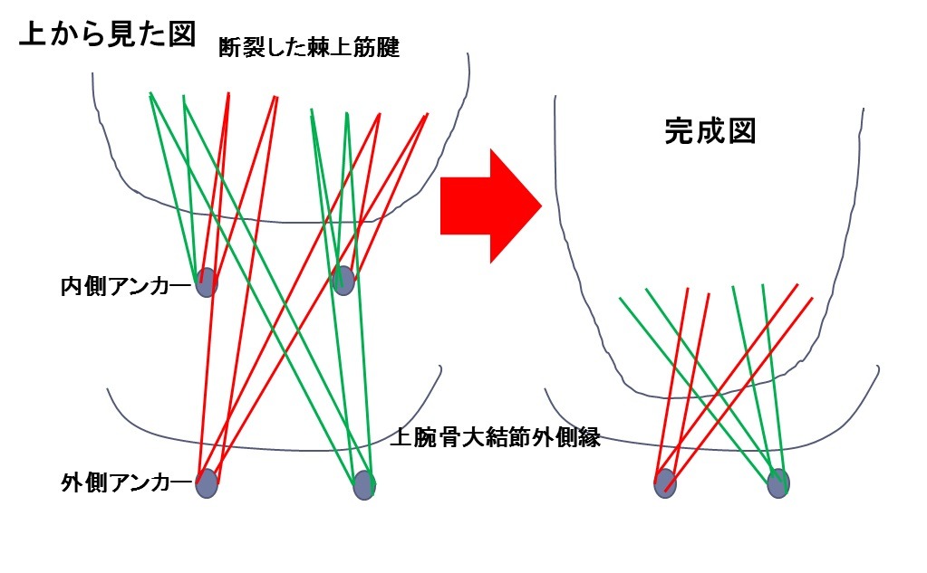 腱板縫合（Suture-bridge法）のシェーマ
