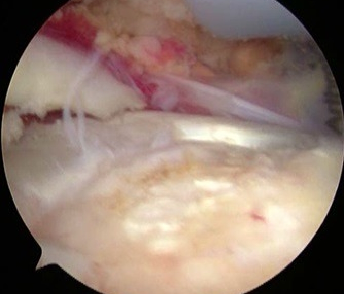 内側アンカー設置1