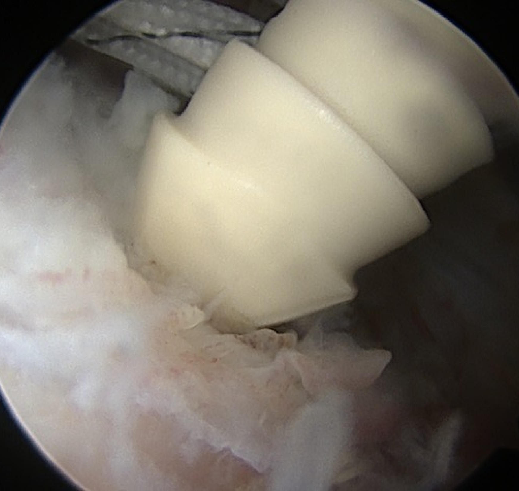 外側アンカー設置2