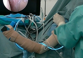 手術中軽度外転位