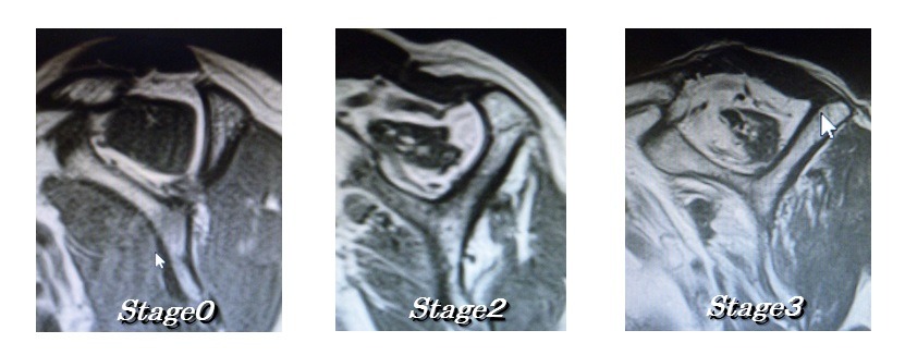 MRIでの正常腱板と断裂像