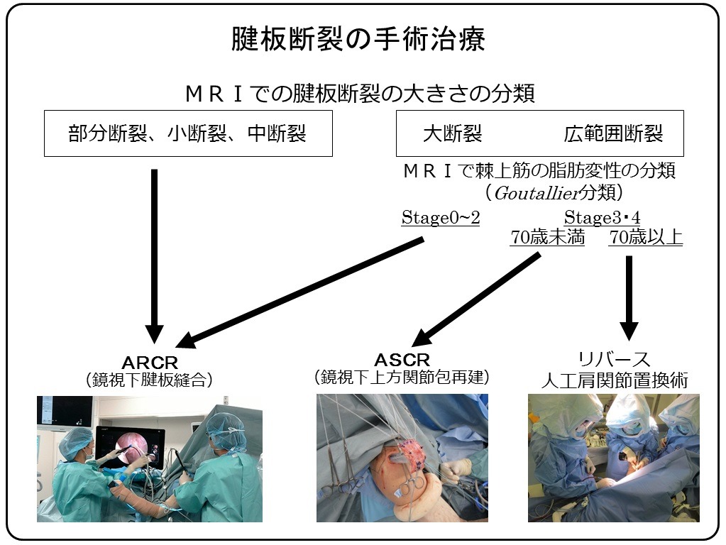 当院での腱板断裂の手術治療フロー