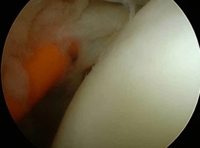 滑膜切除、肩峰下除圧の様子1