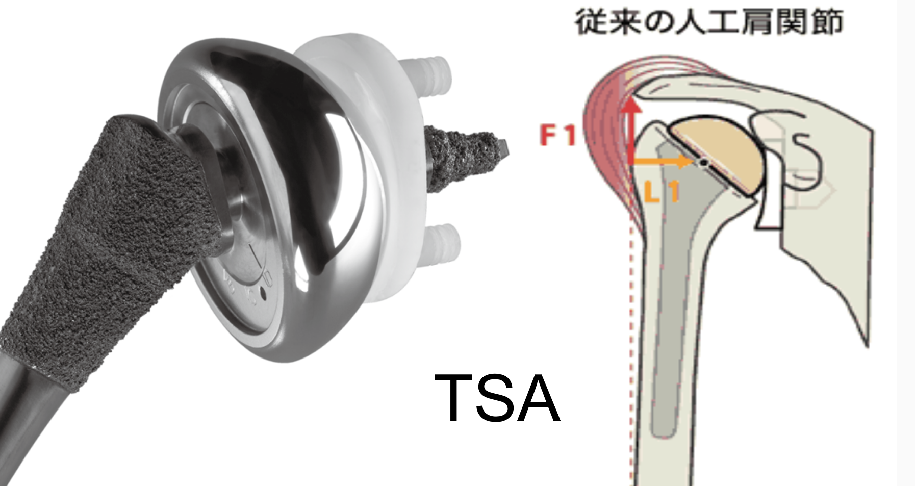 TSAのメカニズム