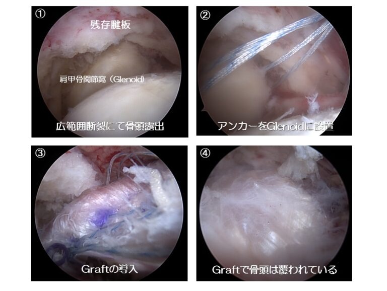 ASCRの手術イメージ2