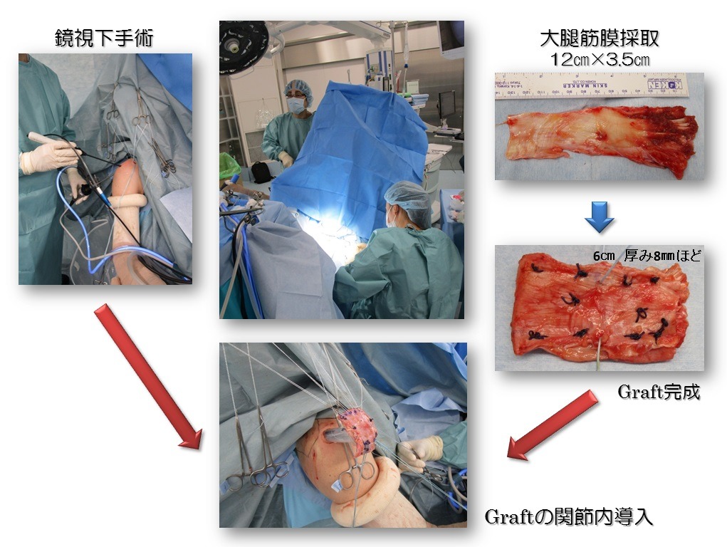 ASCRの手術イメージ1