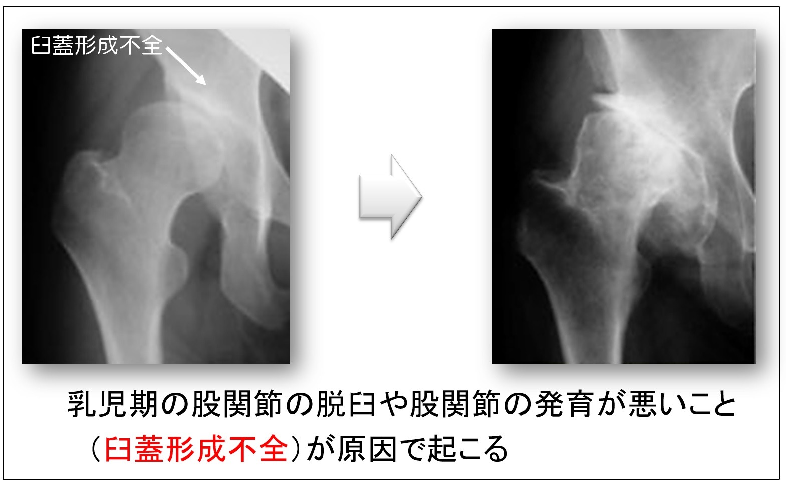 二次性変形性股関節症のレントゲン