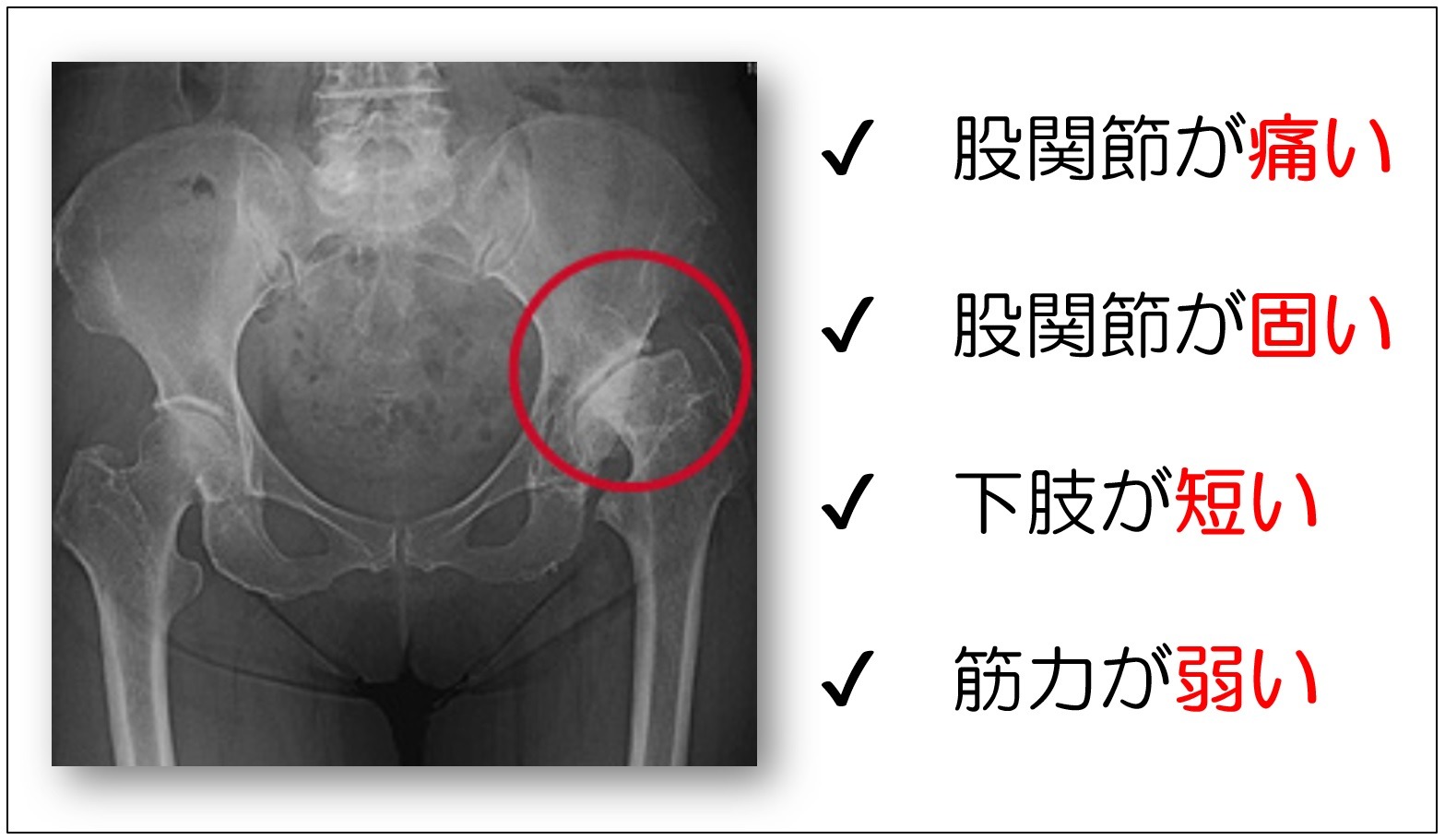 股関節症の4つの症状