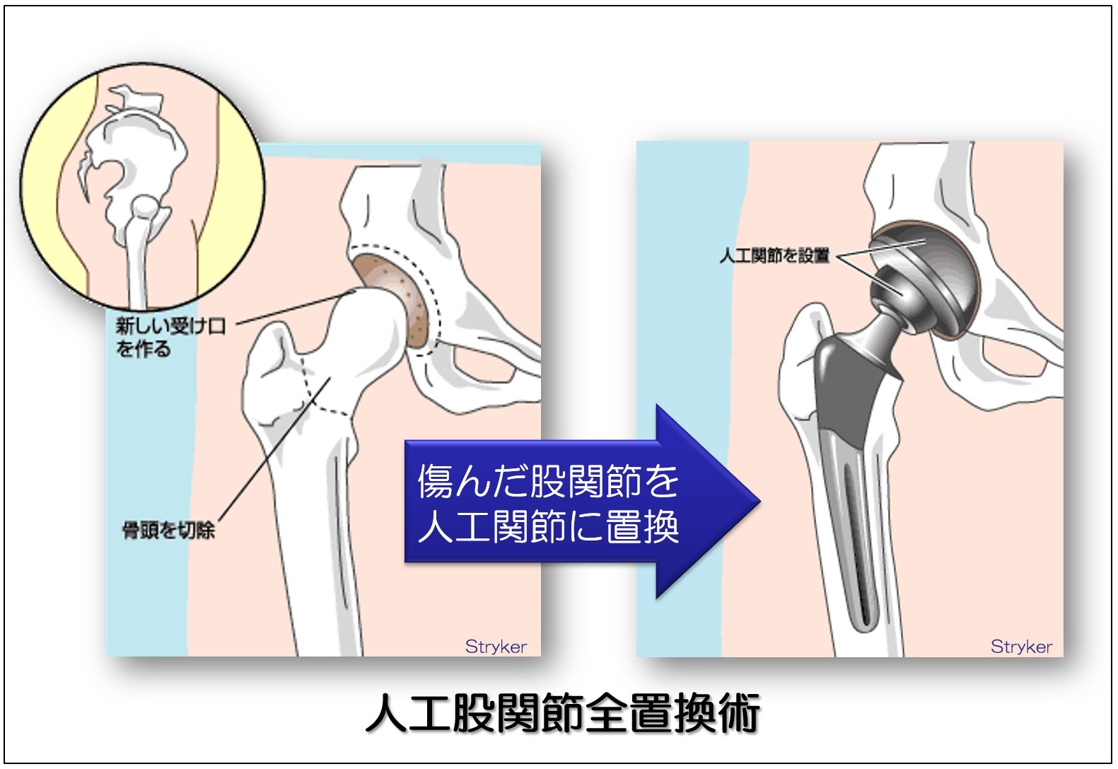 人工股関節全置換術のイメージ