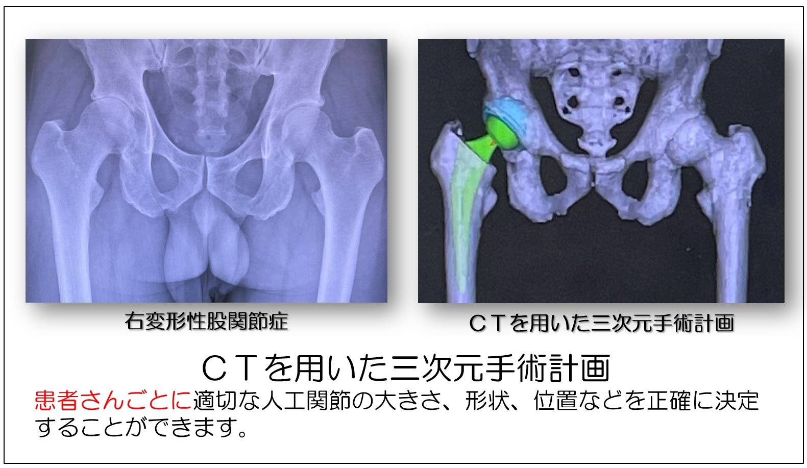 三次元手術計画の画面