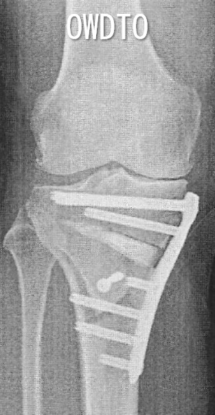 open wedgeとclose wedgeの画像