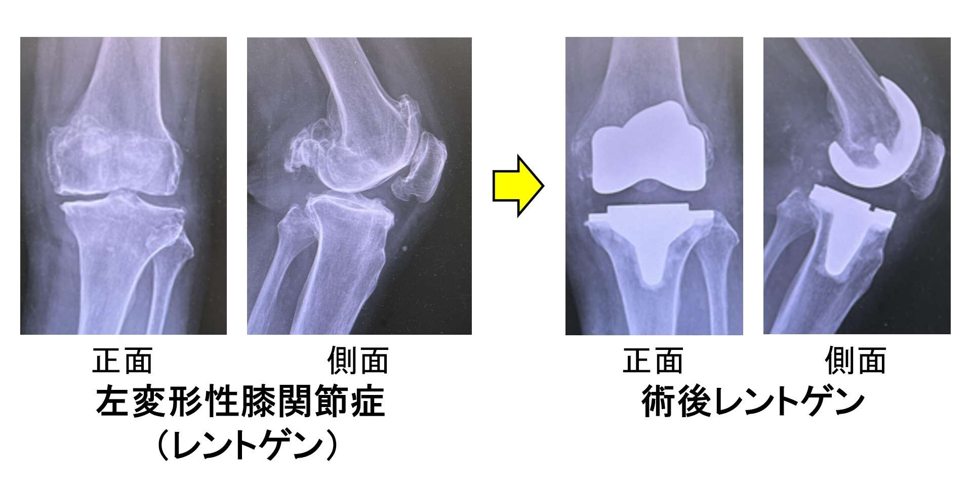 人工膝関節の仕組み2