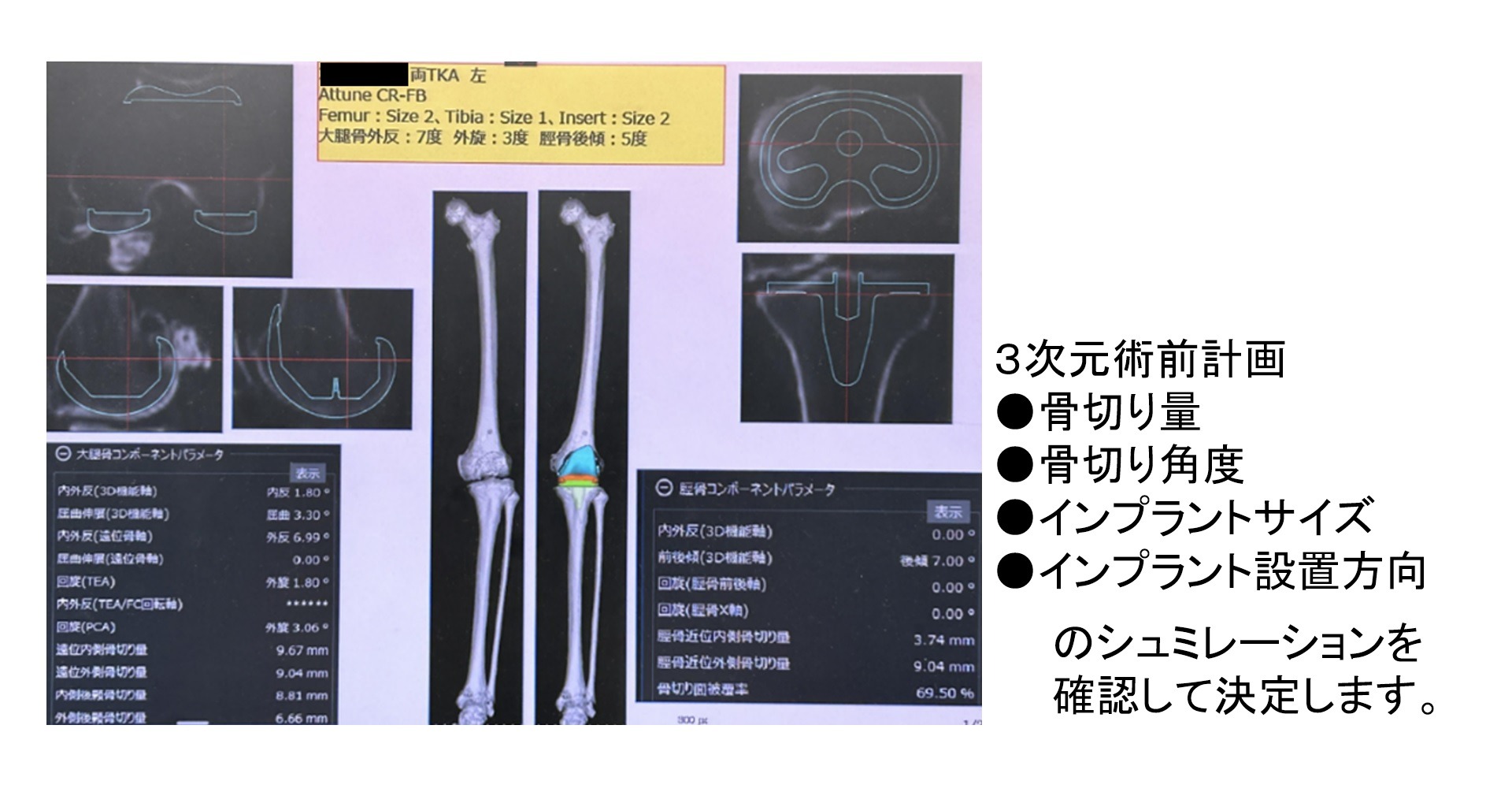 膝の3次元計画2
