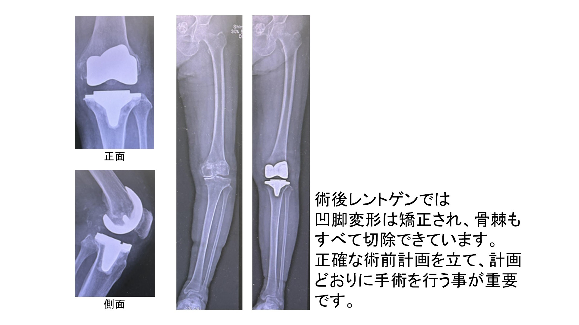 膝の3次元計画3