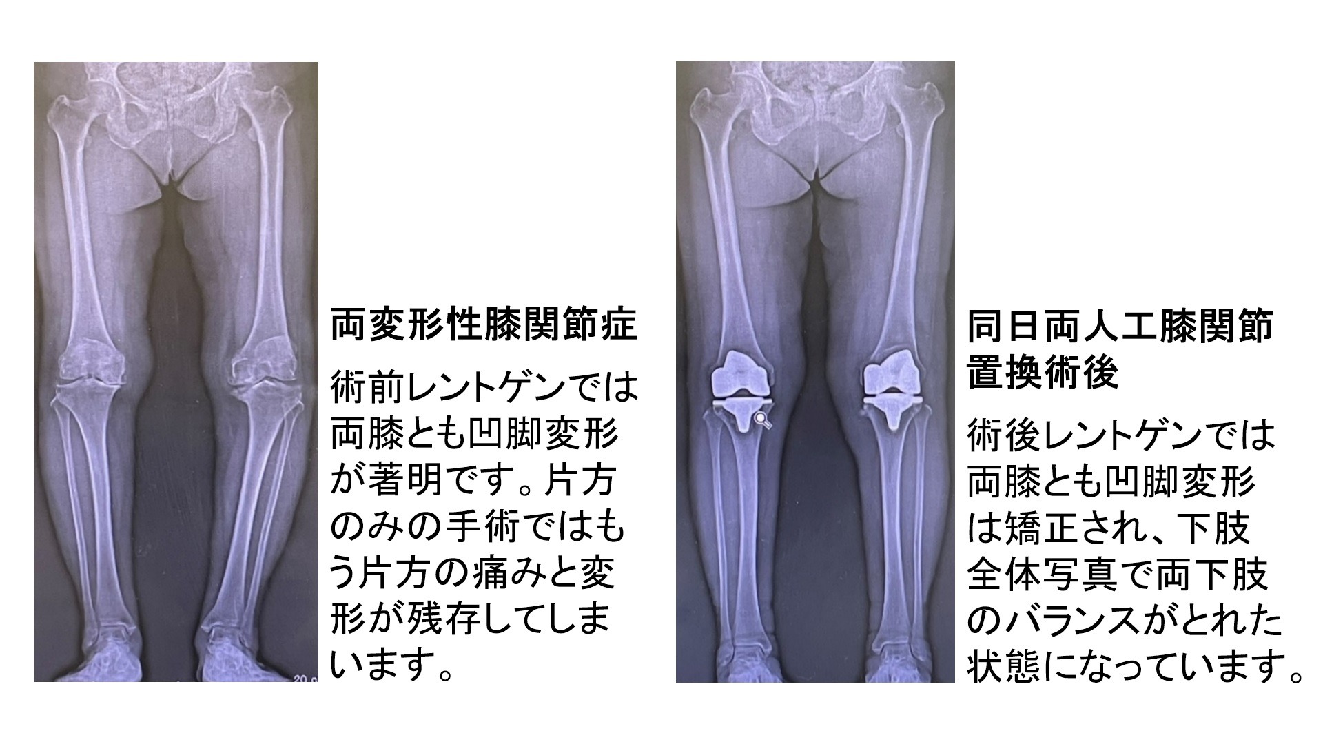 両膝同時手術のレントゲン1