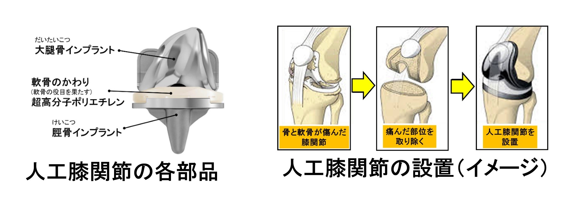 人工膝関節の仕組み1