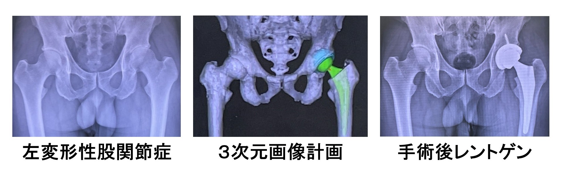 3次元手術計画の画面