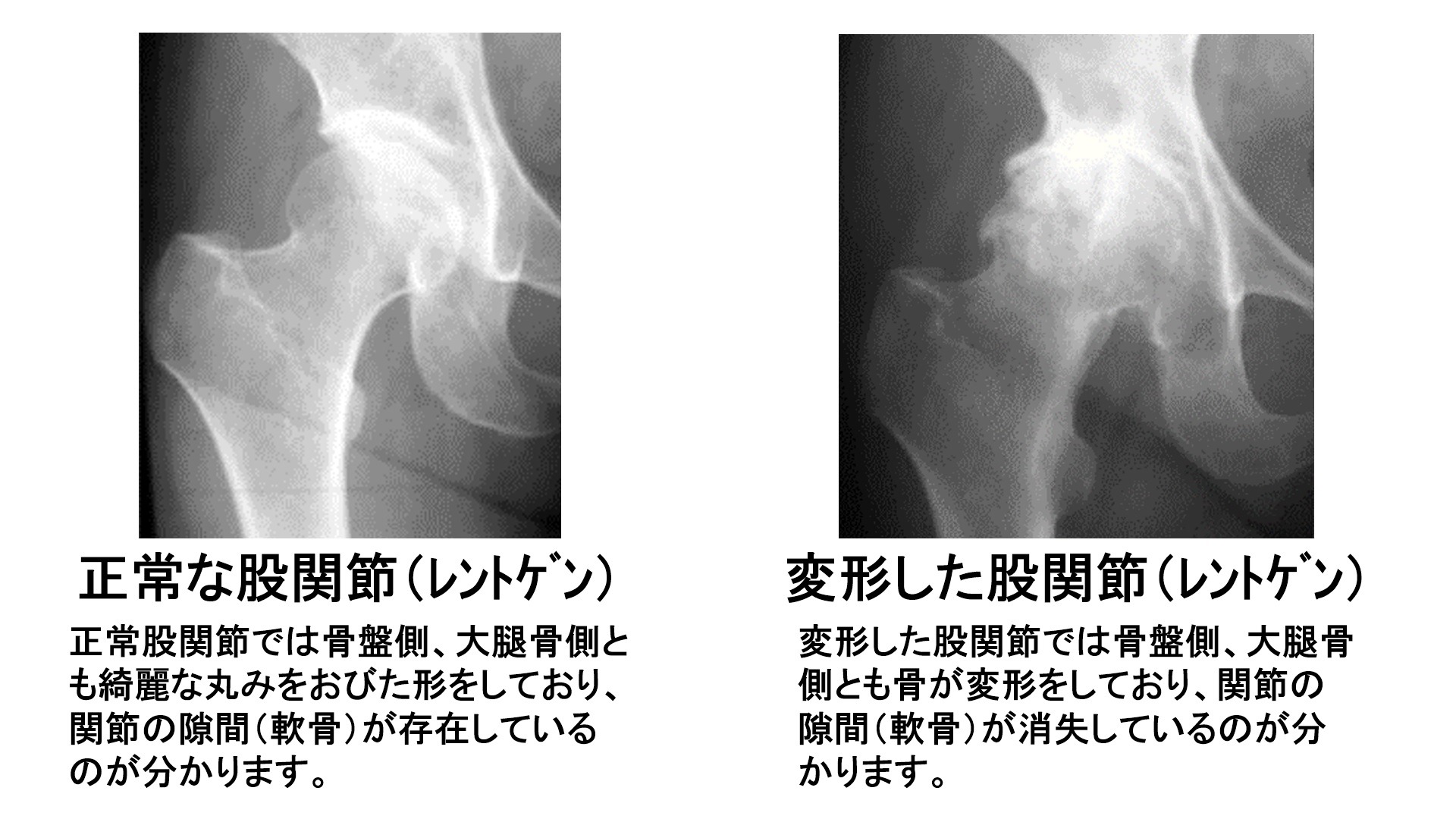 変形性膝関節症のイメージ