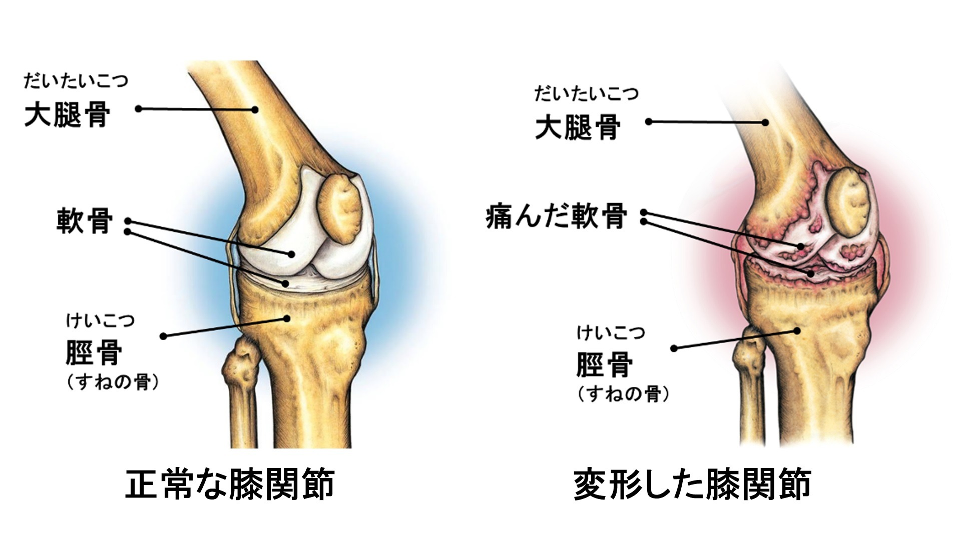 股関節のレントゲン