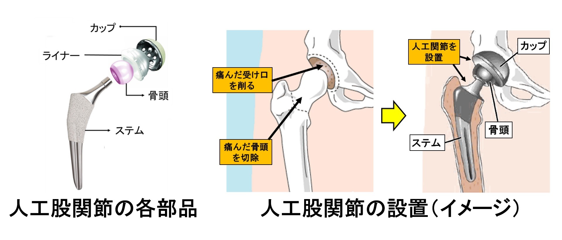 人工股関節の仕組み1