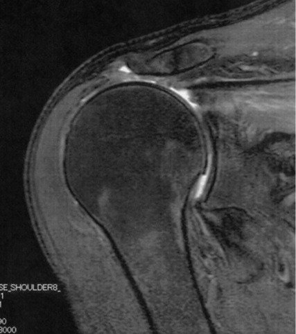 広範囲断裂のMRI