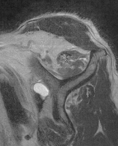 脂肪変性のMRI