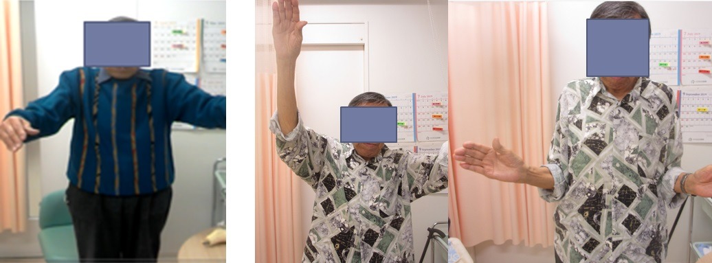 術前術後の比較