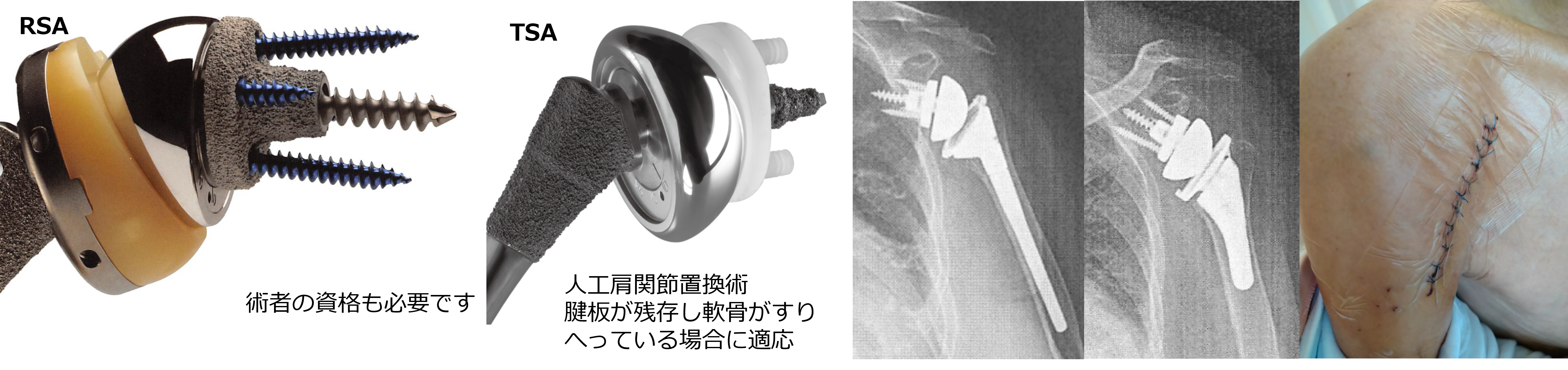 リバース人工肩関節