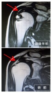 再建腱板の評価