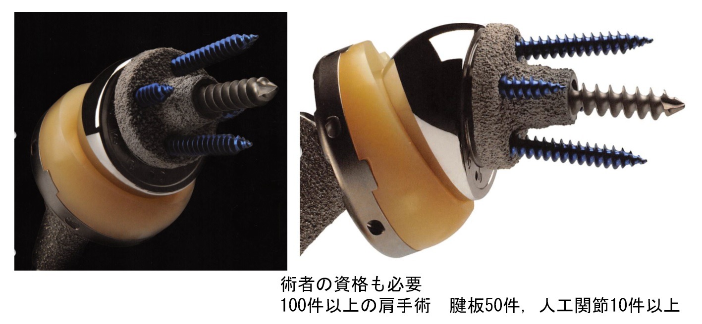 リバース人工肩関節