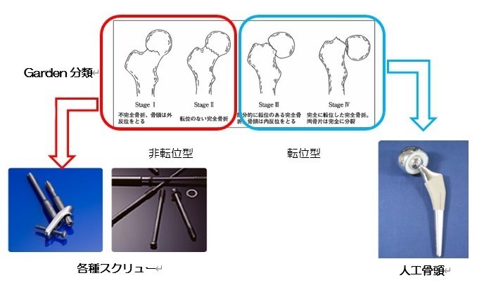 大腿骨頸部骨折の手術