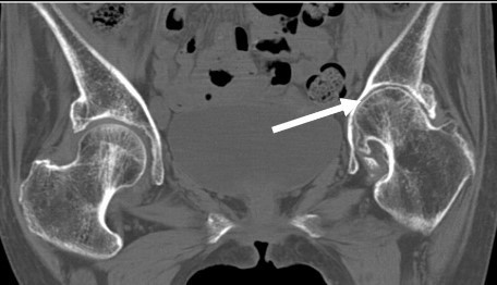 進行した関節リウマチの治療