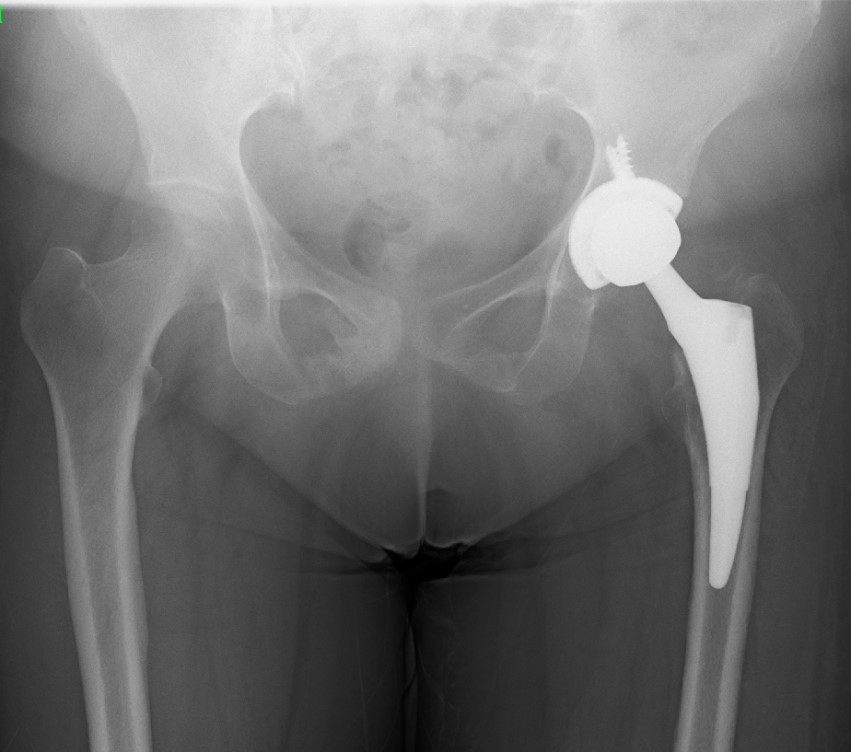 人工股関節置換術の実際